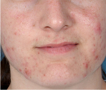 Acne Control  before-after-1