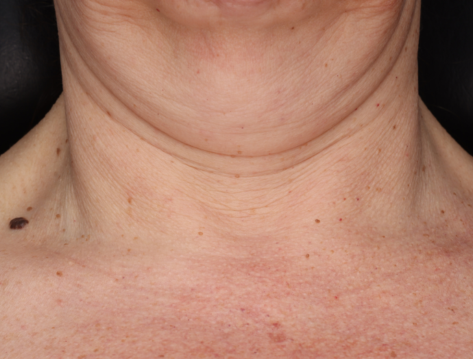 Neck Complex Anti-Aging + Brightening Serum  before-after-1