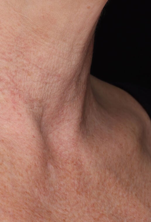 Neck Complex Anti-Aging + Brightening Serum  before-after-3