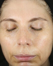 Before and After Image of results from 2 weeks of Renewal Crème Usage