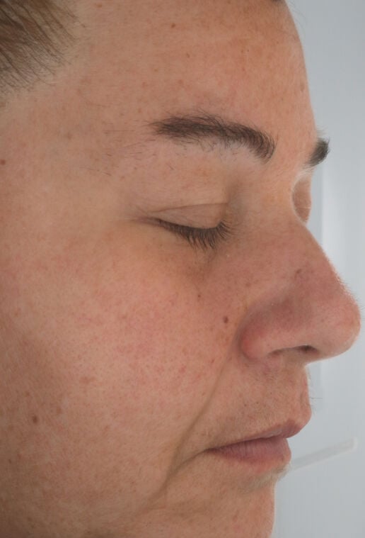 12 weeks after using firming serum