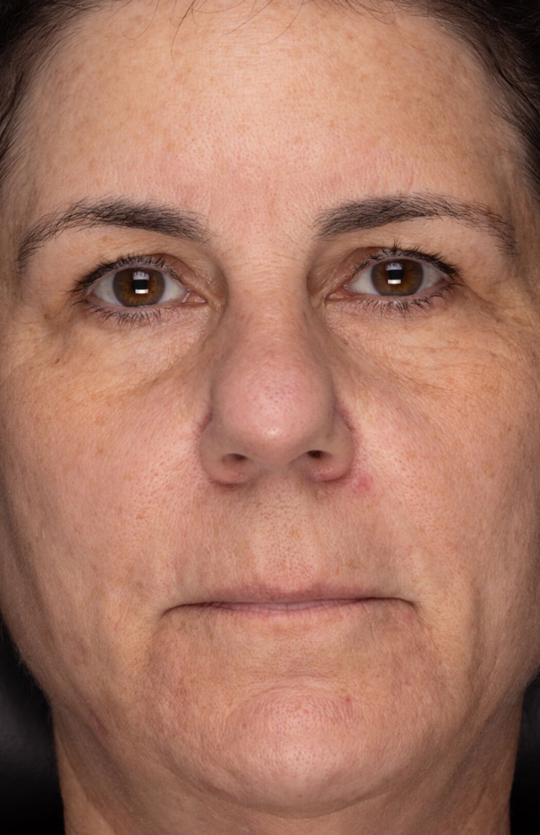 Recovery Cr&egrave;me  before-after-3