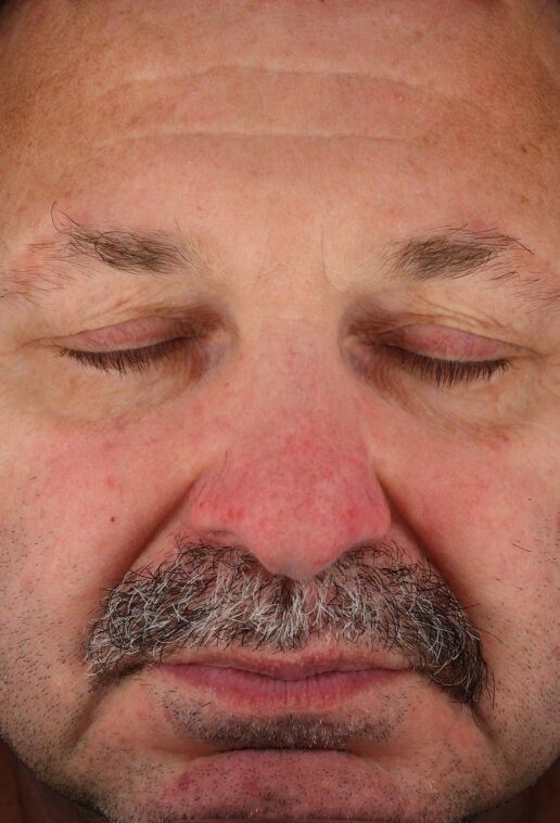 Rozatrol&reg; (Travel Size)  before-after-2