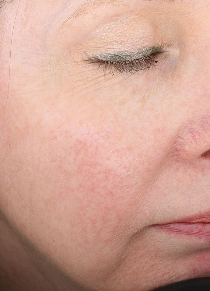 Rozatrol®  before-after-2