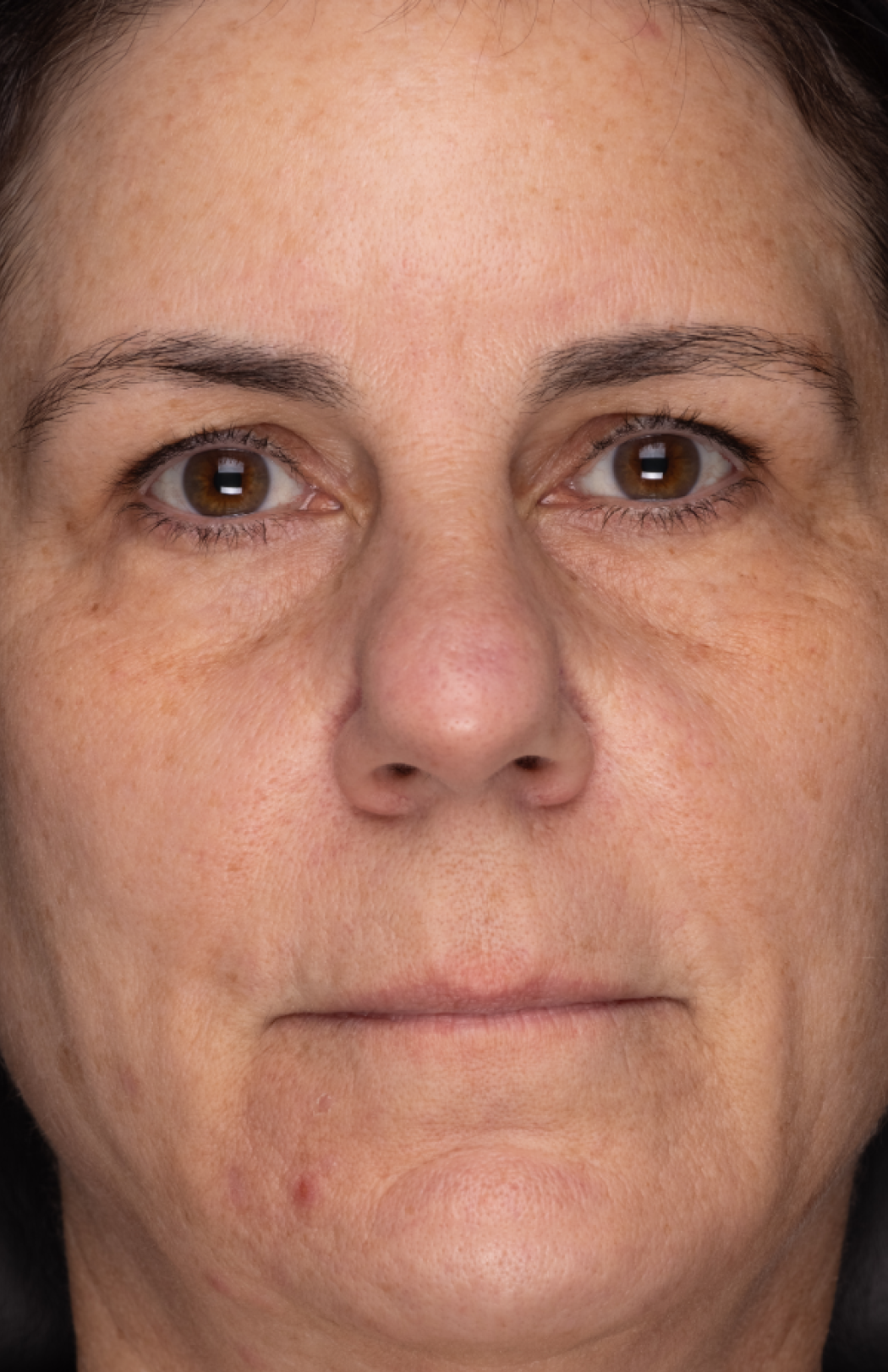 Recovery Cr&egrave;me  before-after-3