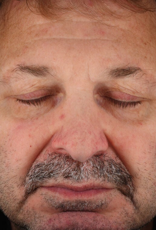 Rozatrol&reg; (Travel Size)  before-after-2