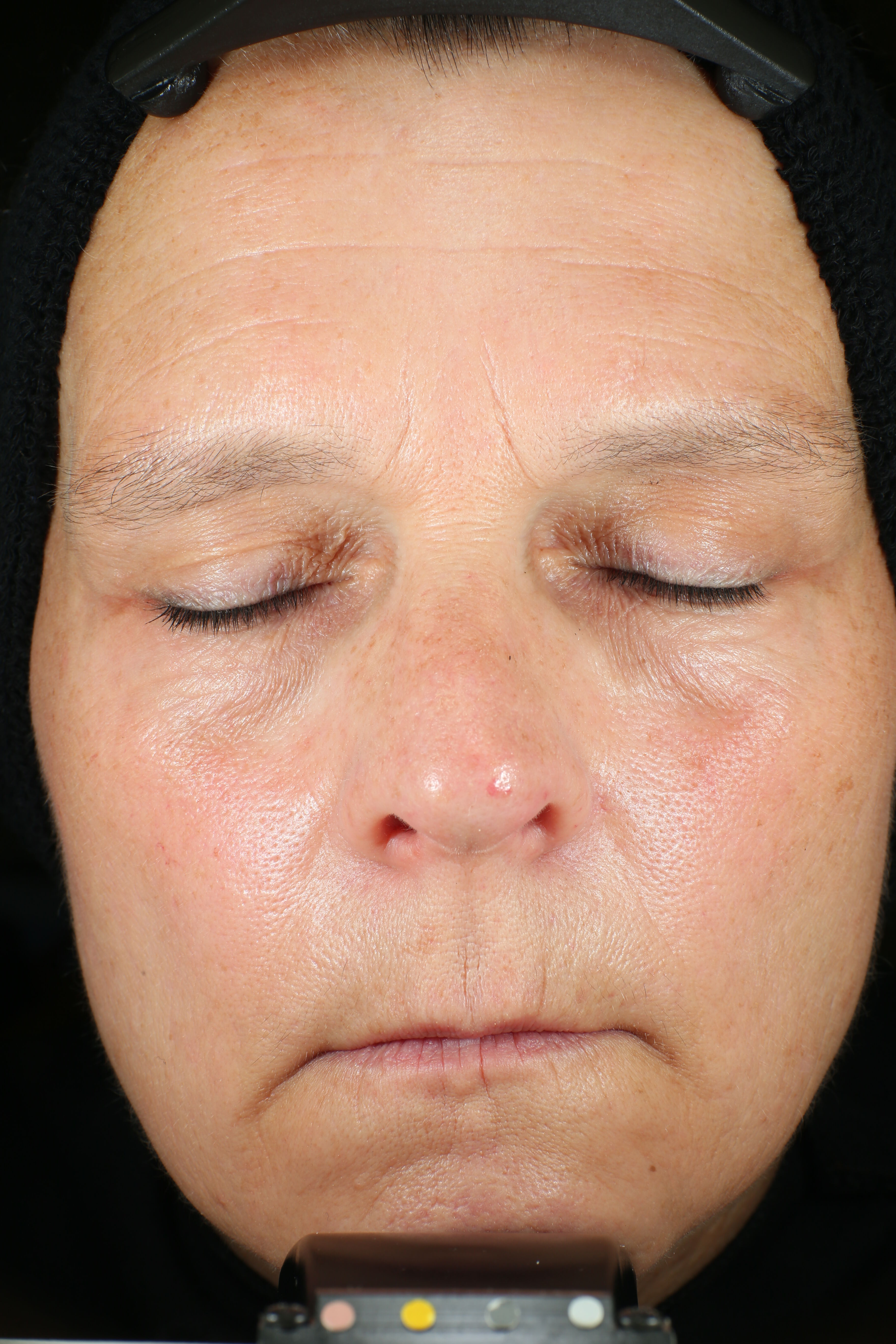 Wrinkle + Texture Repair  before-after-2