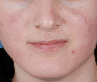 Acne Control  before-after-1