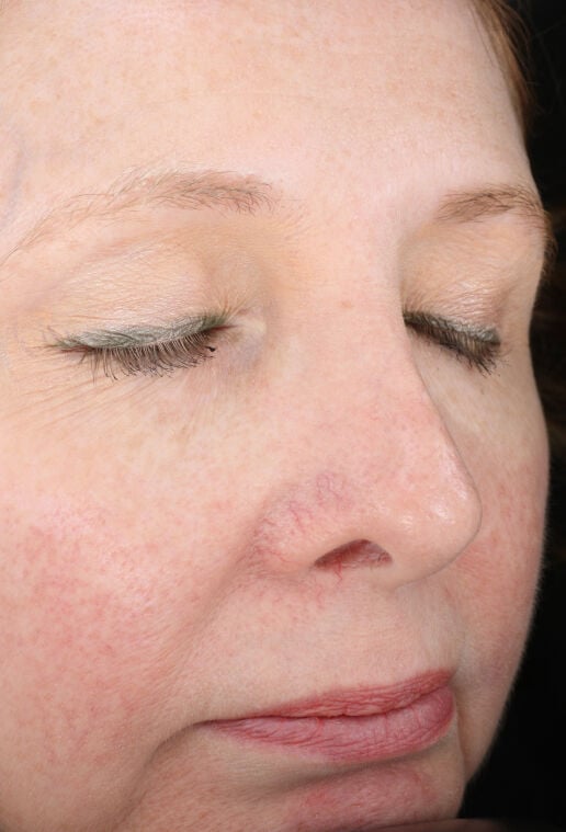 Rozatrol&reg; (Travel Size)  before-after-1