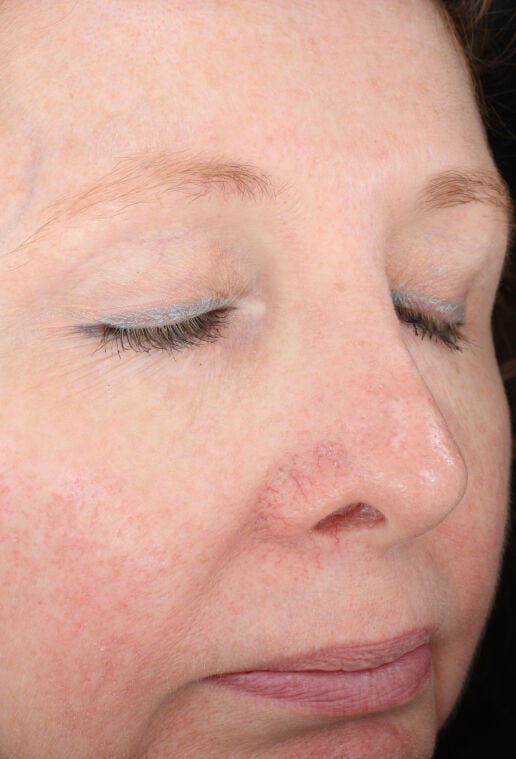 Rozatrol&reg; (Travel Size)  before-after-1