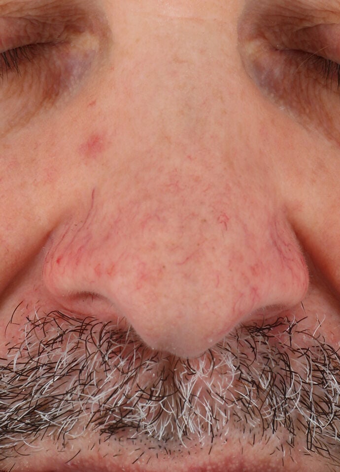 Rozatrol®  before-after-1