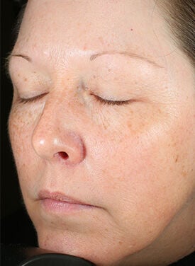 Before and After results from using Brightalive® for 16 weeks