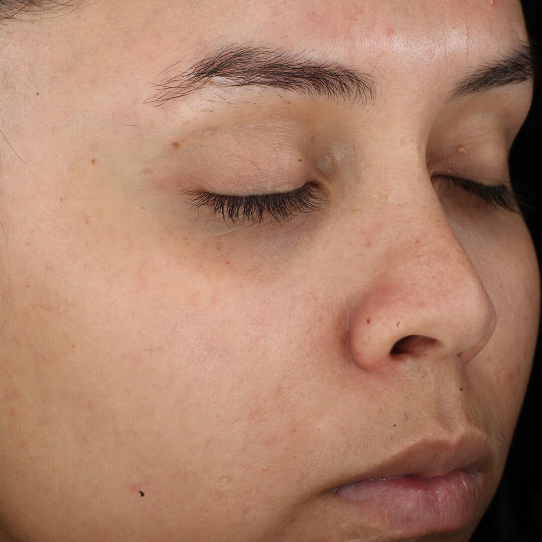 Complexion Clarifying Serum  before-after-2