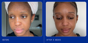 Michaela's ZO Skin Health Story: A Blemish-Prone Skin Protocol That Worked 