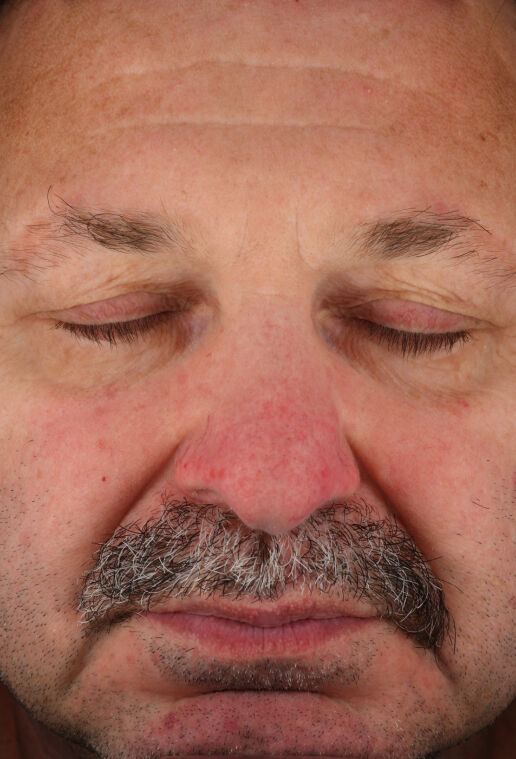 Rozatrol&reg; (Travel Size)  before-after-2