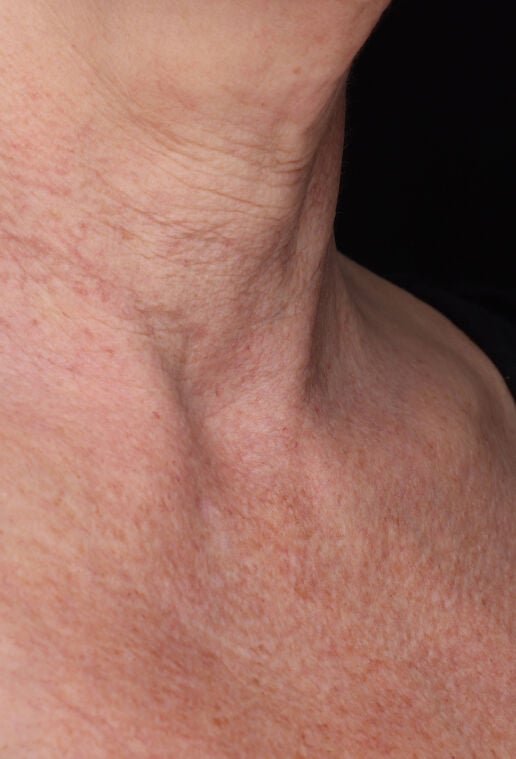 Neck Complex Anti-Aging + Brightening Serum  before-after-3