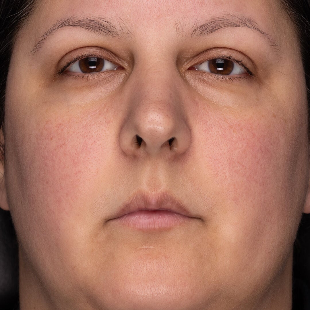 Before and After after 2 weeks of Recovery Cr&egrave;me Usage