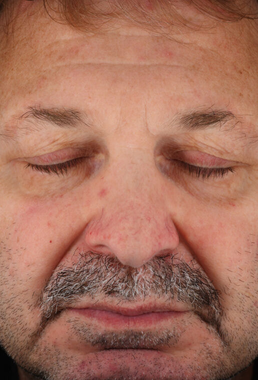 Rozatrol&reg; (Travel Size)  before-after-2