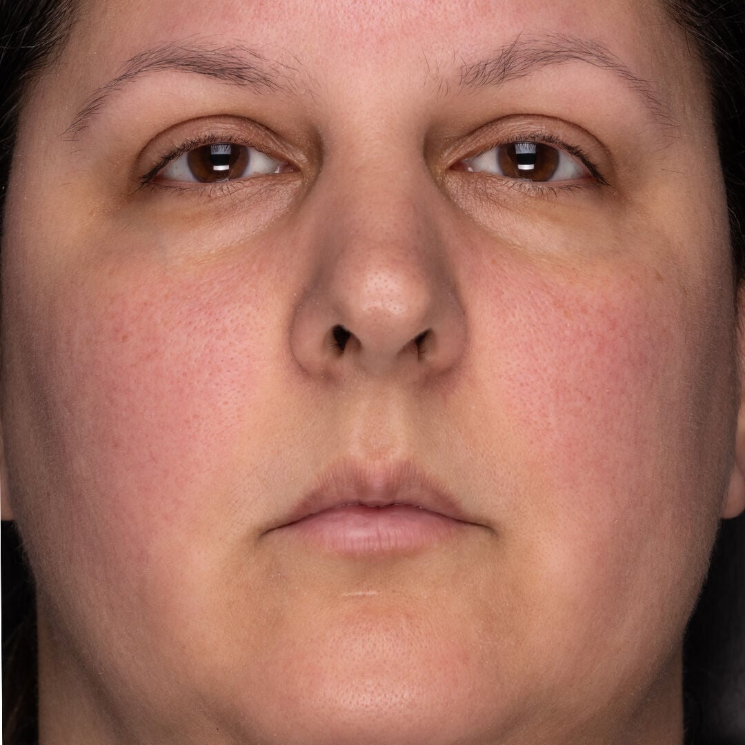 Before and After after 2 weeks of Recovery Cr&egrave;me Usage