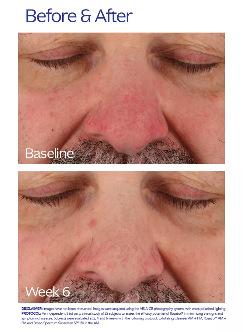 Rozatrol | Redness & Rosacea Serum | ZO Skin Health, Inc. Rozatrol | Redness & Rosacea Serum | ZO Skin Health, Inc.