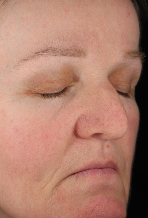 Rozatrol&reg; (Travel Size)  before-after-3