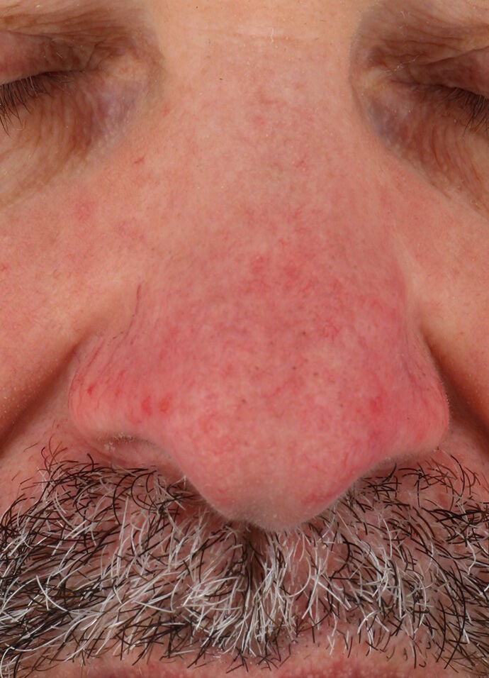 Rozatrol&reg;  before-after-1
